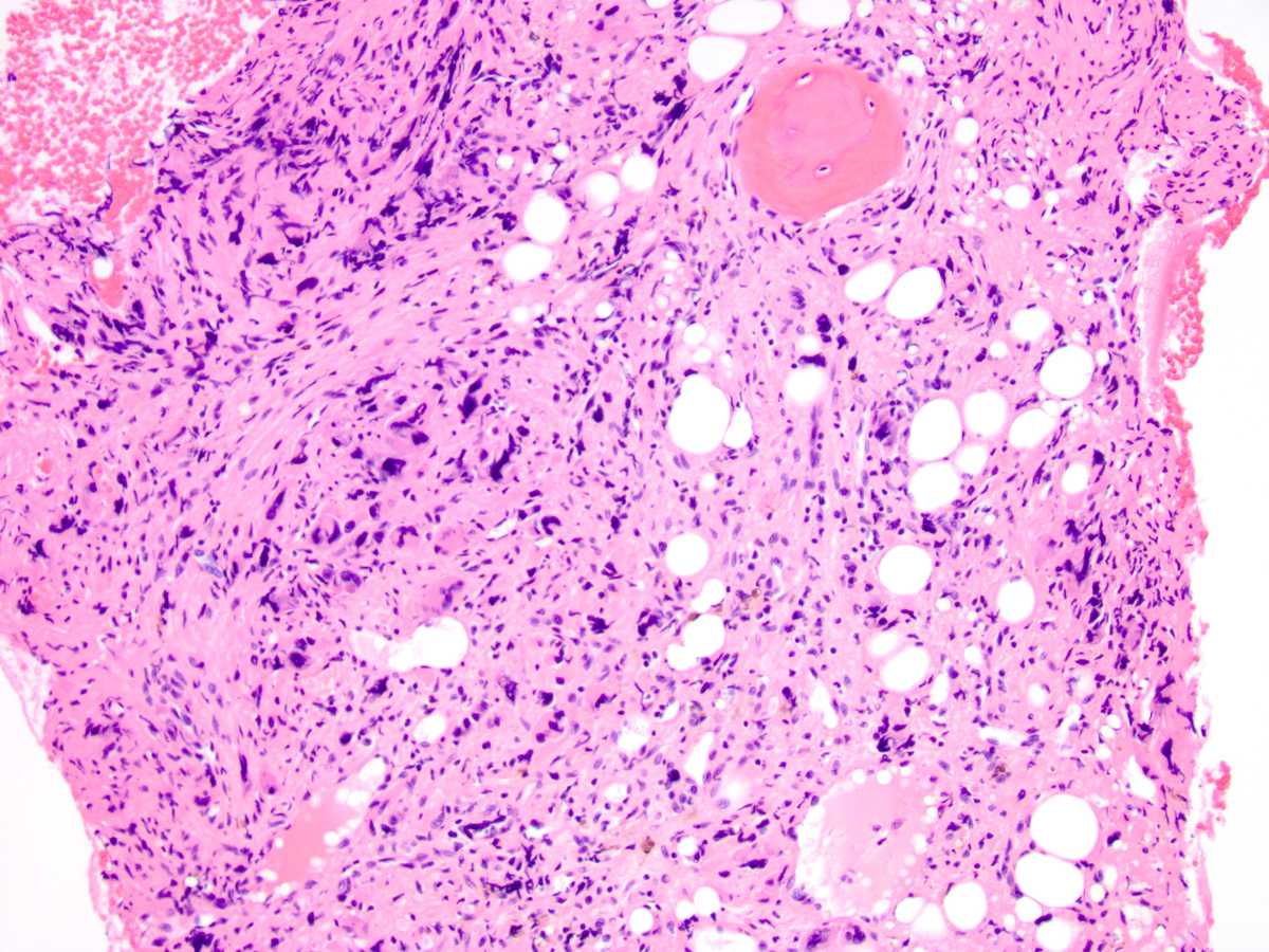 Other areas are more cellular and contain an increased number of atypical megakaryocytes